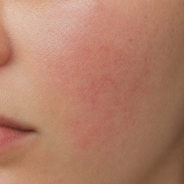 Joue marquée de rougeurs diffuses étendues en gros plan, peau réactive et sensible