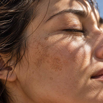 Visage d'une femme au soleil, taches pigmentaires sur la joue, exposome et vieillissement cutané