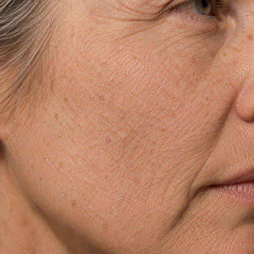 Gros plan sur une joue mature à la peau sèche et rêche, fines squames visibles