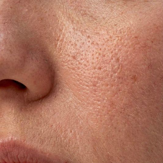 Pores dilatés : comprendre et lisser la texture