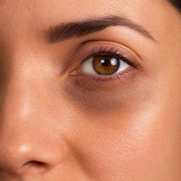 Œil brun d'une femme, cerne marqué sous la paupière, microcirculation du contour de l'œil