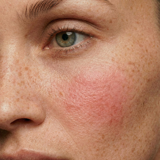 Rougeurs sur les joues : causes et solutions pour apaiser durablement